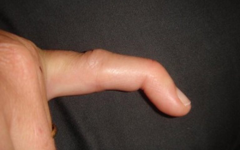 Mallet finger
