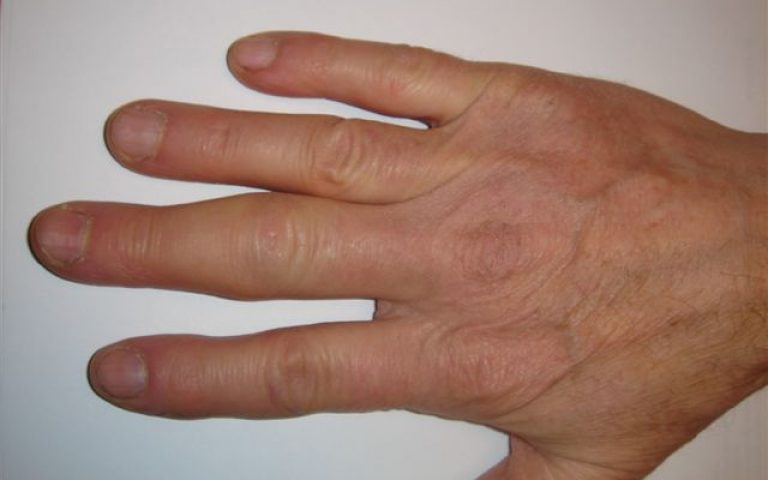 Sprain of the proximal interphalangeal joint of the fingers