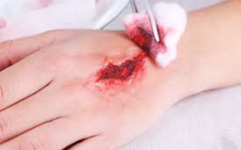Finger extensor wounds