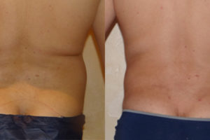 liposuccion hanches
