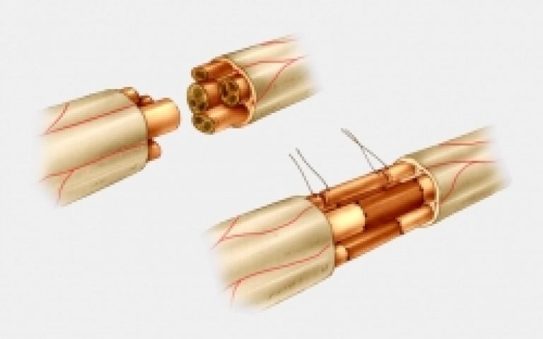 Plaies des nerfs du poignet et de la main
