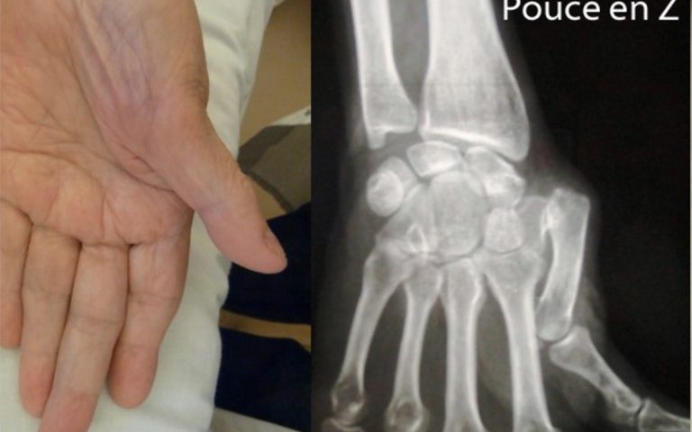 Arthrose post-traumatique