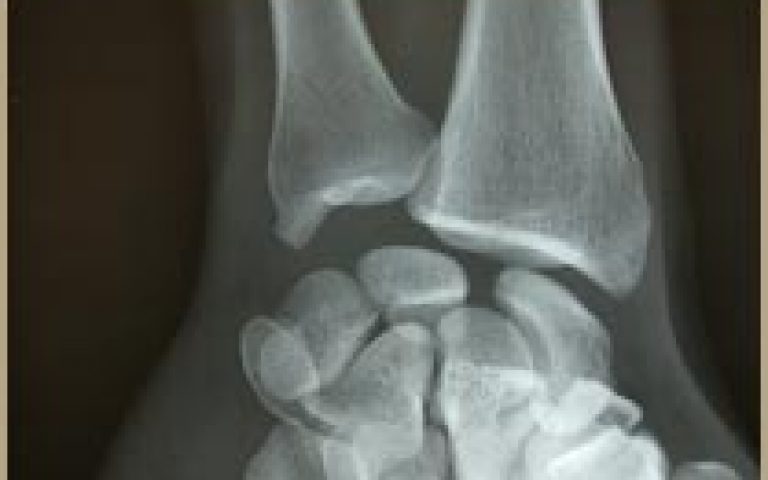 Scapholunate sprain