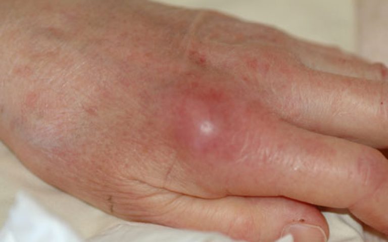 Arthritis of the hand and wrist joints