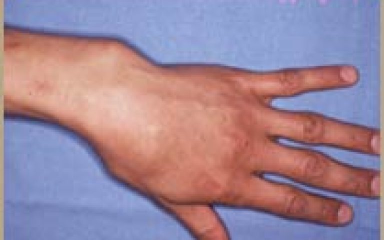 Cal vicieux du poignet et de la main