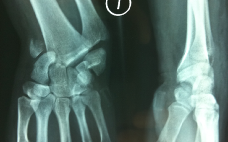 Carpal dislocation