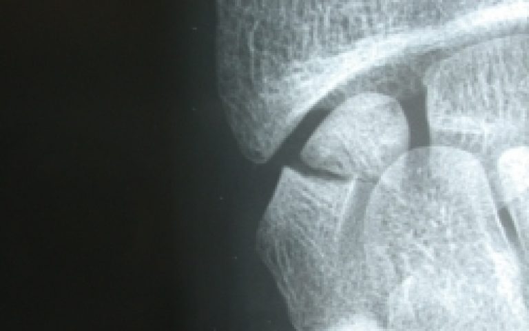 Pseudarthroses du scaphoïde