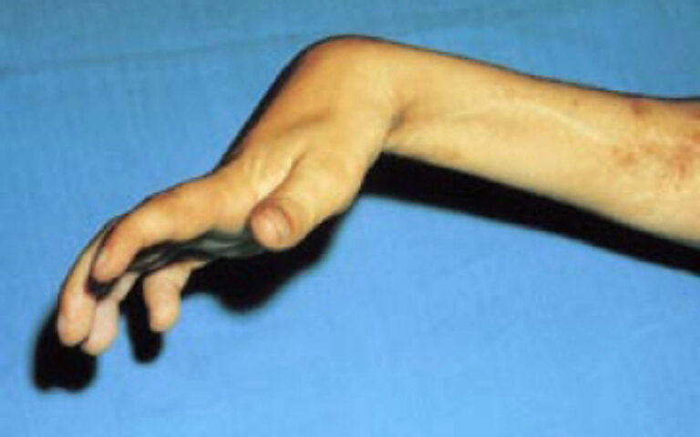 Compartment syndrome