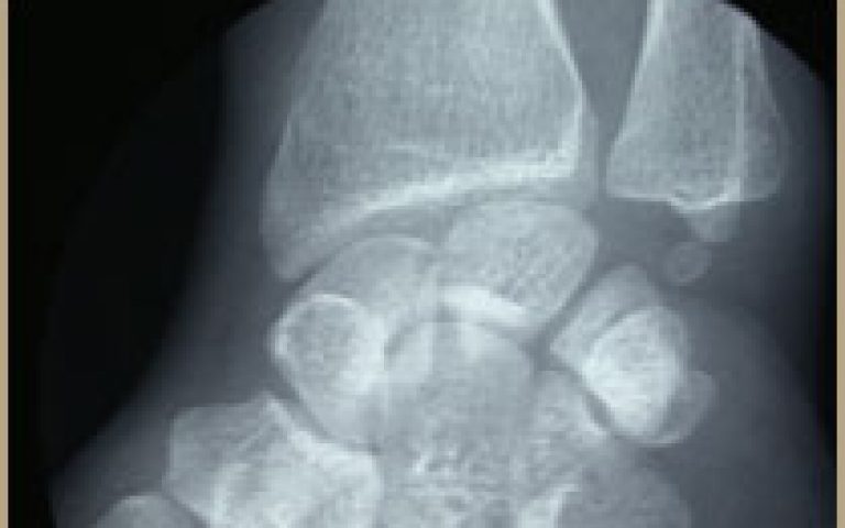 Syndrome du cubitus long