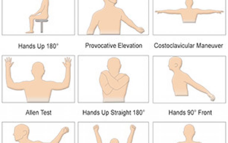 Syndrome du défilé cevico-thoracique