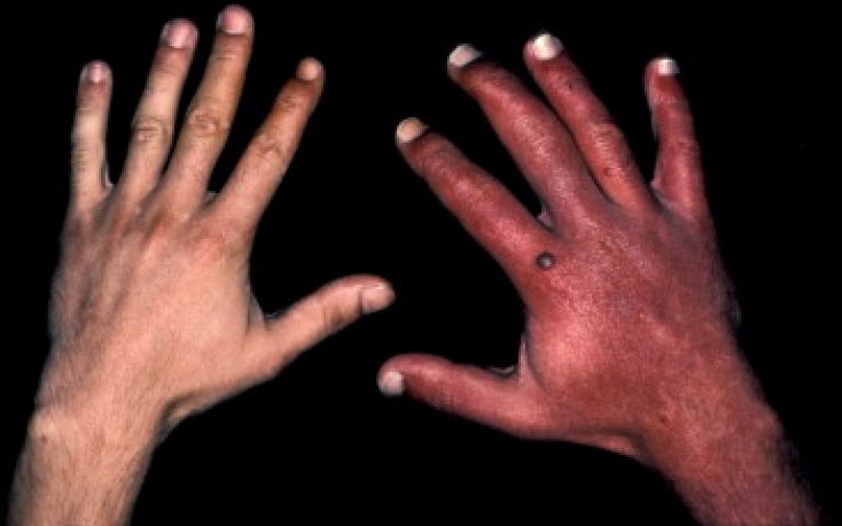 Malformation vasculaire de la main