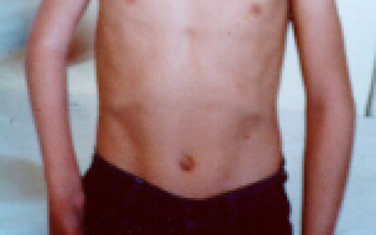 Paralysie traumatique du plexus brachial