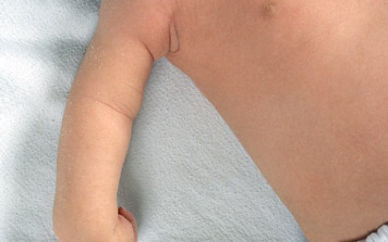 Paralysie obstétricale du plexus brachial