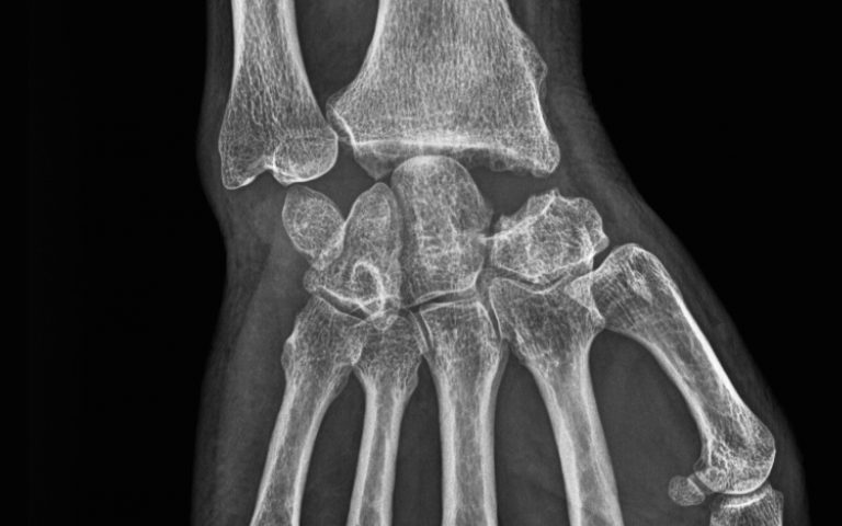 Arthrose du poignet